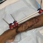 Soft tissue reconstruction