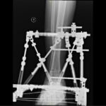 Hexapod in ankle deformity correction