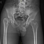 neck of femur fracture