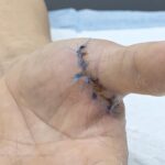 Laceration at the base of thumb