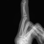 fracture base of distal phalanx