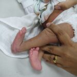 Calcaneovalgus deformity